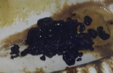 黑便一定是消化道出血吗,消化道出血的信号？